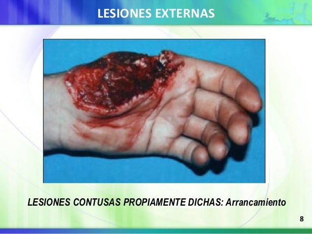 lesiones contusas medicina legal